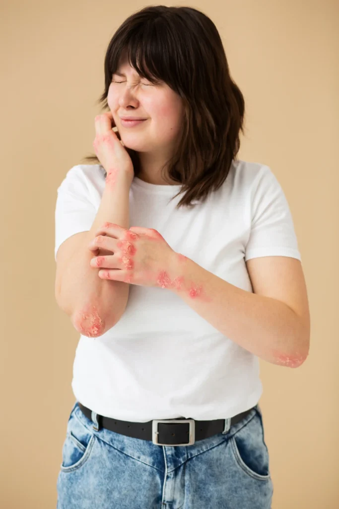 Woman with red irritated skin on hands and elbows showing signs of infection or inflammation.